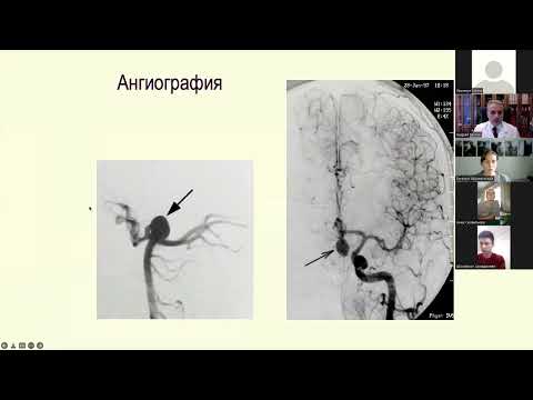 Видео: Интенсивная терапия нетравматического субарахноидального кровоизлияния