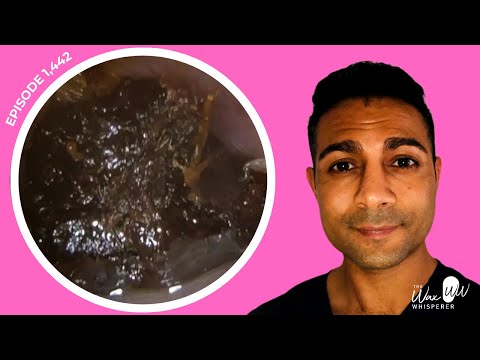 Видео: 1442 — массы ушной серы, вызывающей оглушительный шум, удалены с помощью новой функции ZOOM и тон...