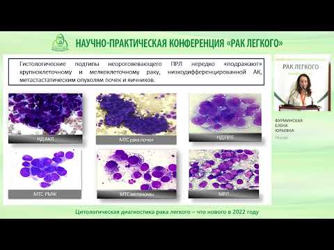Видео: Цитологическая диагностика рака легкого – что нового в 2022 году