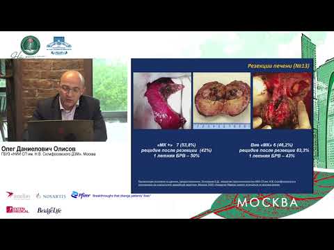 Видео: A2. Трансплантация печени при ГЦР - опыт НИИ Склифосовского