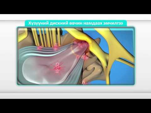 Видео: "Часэн эмнэлэг" Хүзүүний зөөлөн эдийн эмчилгээ