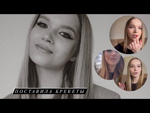 Видео: ПОСТАВИЛА БРЕКЕТЫ // РЕЗУЛЬТАТЫ ЗА 2 МЕСЯЦА, СТОИМОСТЬ, ВПЕЧАТЛЕНИЯ