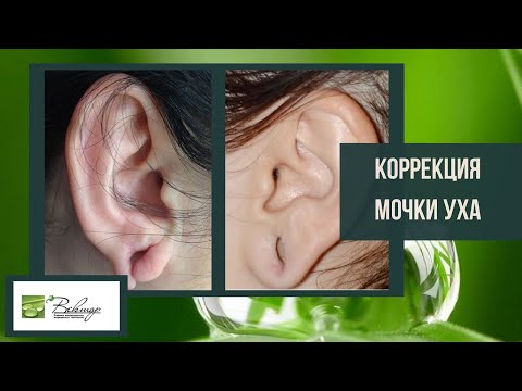 Видео: КОРРЕКЦИЯ МОЧКИ УХА - все о процедуре от хирурга. Ревин Артем Андреевич.