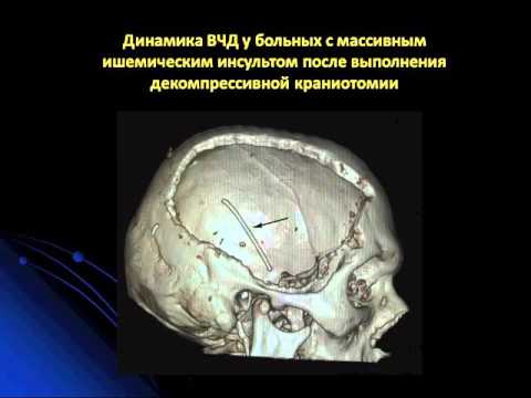 Видео: Интенсивная Терапия ОНМК  Петриков С  С