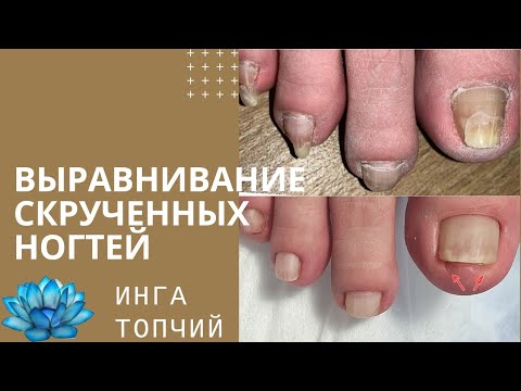 Видео: Вросший ноготь. Проблемные ногти. Выравнивание скрученных ногтей на ногах.