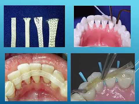 Видео: Пародонт тўқимаси касалликларини ортопедик даволаш усуллари ва профилактикаси
