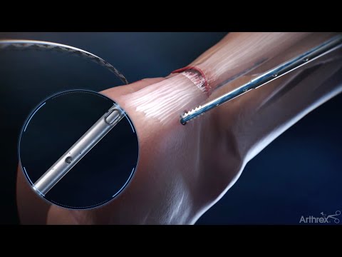 Видео: Хирургическая техника SpeedBridge™ для ахиллова сухожилия