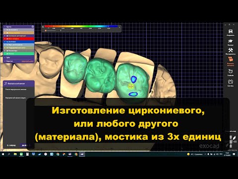 Видео: Циркониевые коронки в exocad Изготовление мостика Моделирование зубов Видео с индивидуального курса.