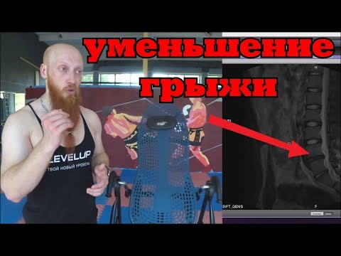 Видео: Грыжа позвоночника. Лечение, супер результат!