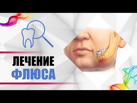Видео: Флюс от зуба [боль, гной, отёк, абсцесс]. Развитие кариес - #пульпит - #периодонтит - #киста - #флюс