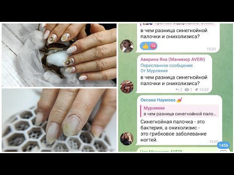 Видео: Новая клиентка с онихолизисом. Это синегнойка и грибок !
