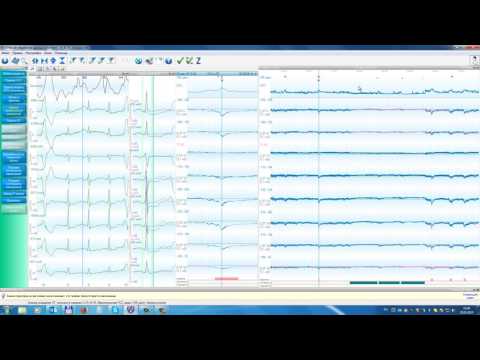 Видео: Result2/3. Страница «Оценка ишемических изменений», общий обзор.