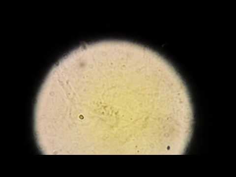 Видео: ЦИЛИНДРЫ гиалиновые в моче!