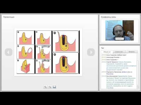Видео: 2014 01 21 Расщепление альвеолярного гребня  0001