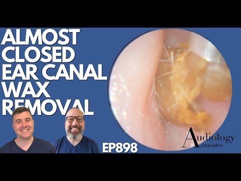 Видео: Удаление почти закрытого ушного канала серы - EP898