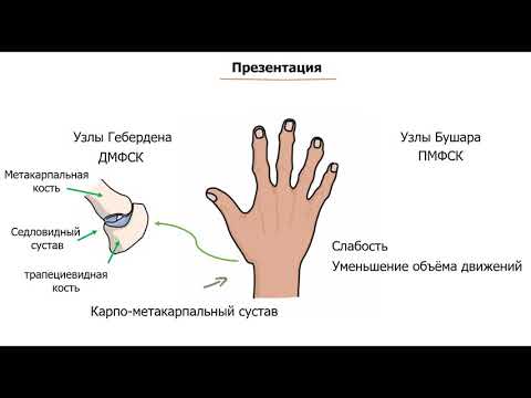 Видео: остеоартрит (остеоартроз) ОА  - определение, этиология, патогенез, клиника, диагностика, лечение