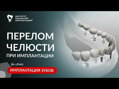 Видео: Развеяли миф: перелом челюсти во время имплантации | Бащальная