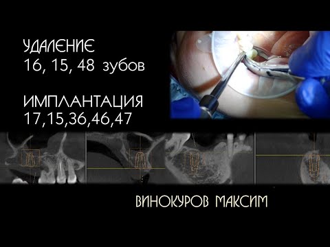 Видео: Удаление 16,15,48 зубов. Имплантация 17,15,36,46,47.
