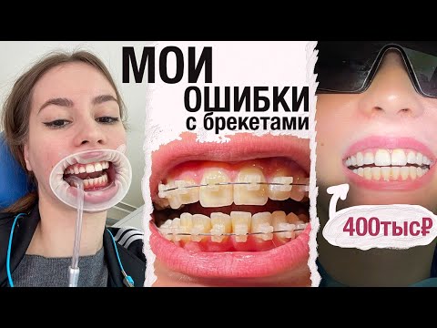 Видео: Мои Ошибки- Как потратить меньше ДЕНЕГ на Брекеты? Какие выбрать?