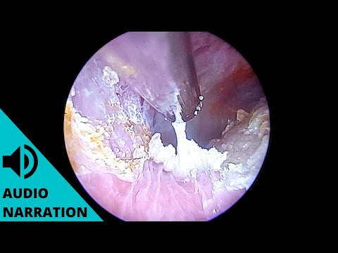 Видео: Инфекция приводит к заполнению уха омертвевшей кожей (острая диффузная десквамация).