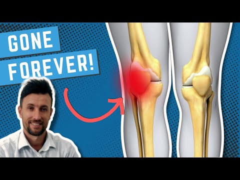Видео: Как навсегда вылечить синдром боли в пателлофеморальном суставе (ПФБС)
