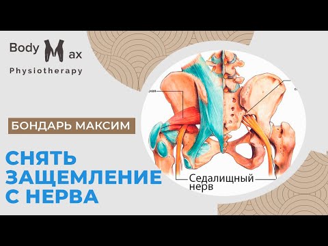 Видео: Как снять защемление с седалищного нерва