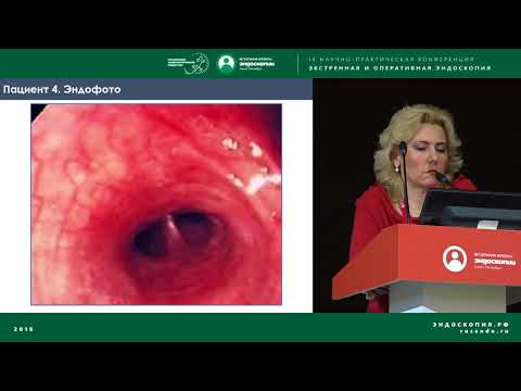 Видео: Экстренная бронхоскопия. Сложный пациент
