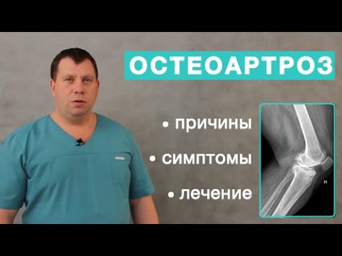 Видео: Остеоартроз. Причины, симптомы и лечение остеоартроза. Отличие артрита от остеоартроза