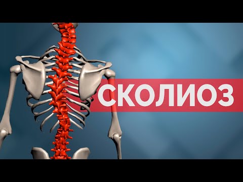 Видео: Сколиоз. Что это? Как протестировать?