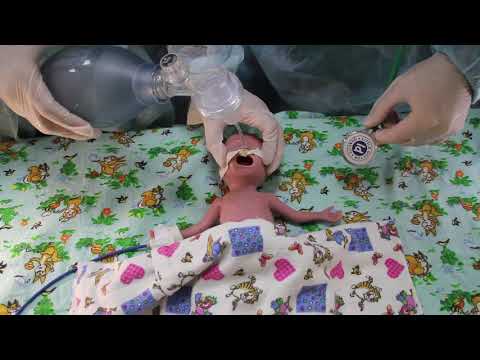 Видео: Реанимация и стабилизация состояния новорожденных детей в родильном зале