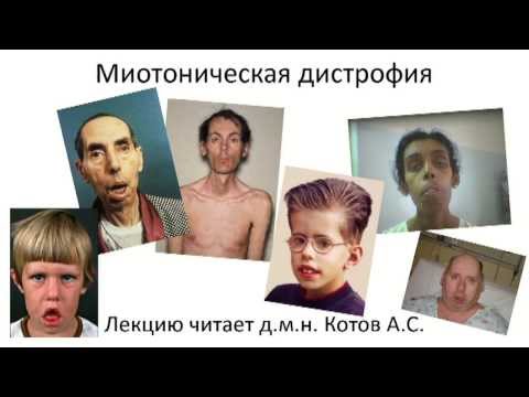 Видео: Миотоническая дистрофия