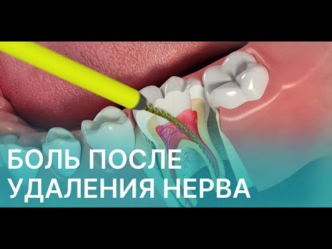 Видео: Болит зуб после удаления нерва — норма или тревога?
