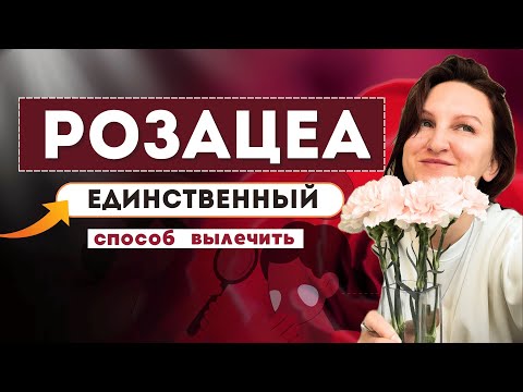 Видео: Розацеа: единственный способ сделать кожу здоровой навсегда (открытая лекция, комплексный подход)