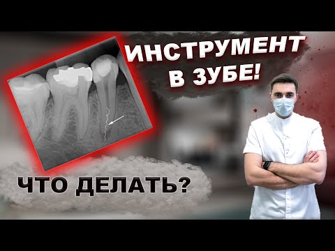 Видео: ИНСТРУМЕНТ В ЗУБЕ! Что делать? #стоматология #лечениезубов