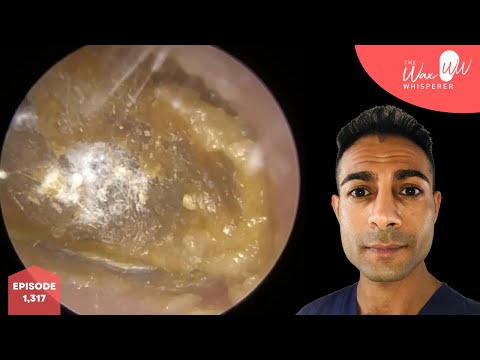 Видео: 1,317 - Удаление ушной серы, покрытой грибком