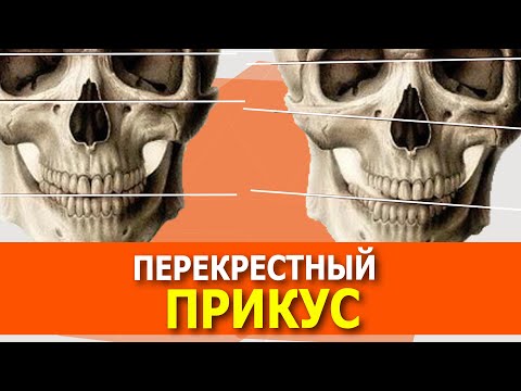 Видео: Перекрестный прикус как исправить. От чего меняется прикус. Исправление прикуса, как выровнять зубы