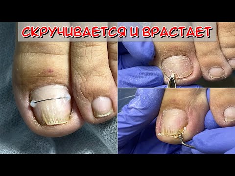 Видео: Установка коррекционной системы / Коррекция вросших ногтей