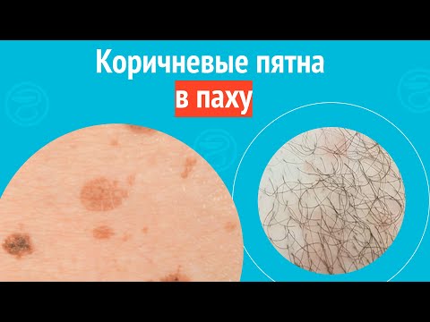 Видео: ⏸️ Коричневые пятна в паху. Клинический случай №1558