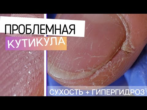 Видео: ОСТОРОЖНО крем для рук: гипергидроз + сухость 🤕 ЗИМНИЙ маникюр 2021 🧊 Наращивание: ЛЕД на ногтях