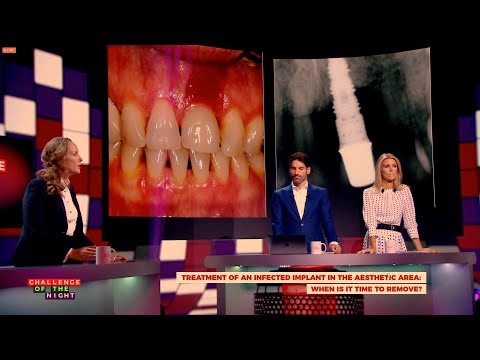 Видео: Испытание. Лечение инфицицированных имплантатов в эстетической зоне: когда уже пора удалять?