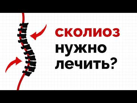 Видео: Сколиоз: простыми словами о сложном диагнозе