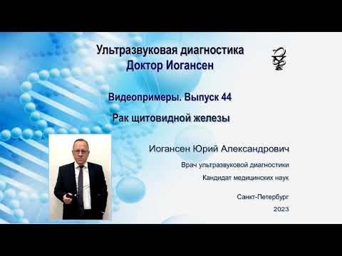 Видео: Ультразвуковая диагностика (УЗИ). Доктор Иогансен. Видеопримеры. Выпуск 44. Рак щитовидной железы.