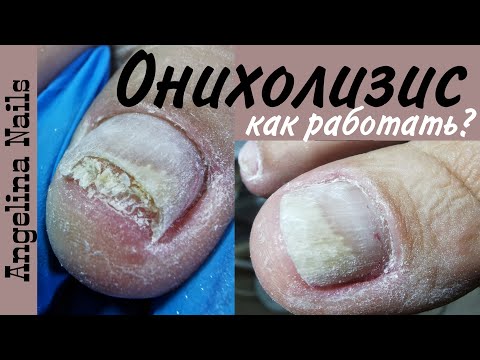 Видео: СЛОЖНЫЙ ПЕДИКЮР / зачистка онихолизиса  как выполнять  правильно /скоростная  дисковая  техника