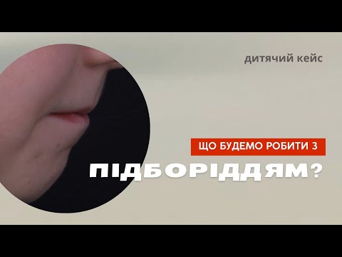 Видео: Якщо ПІДБОРІДДЯ дуже задвинуте назад | Дитяча ортодонтія | Розбір плану лікування | Б. Свінціцький