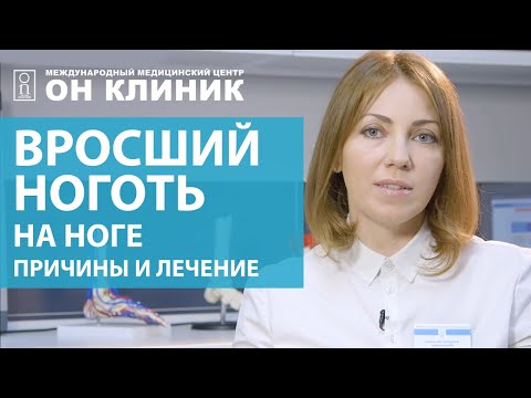 Видео: Вросший ноготь на ноге. Причины и лечение вросшего ногтя без хирурга