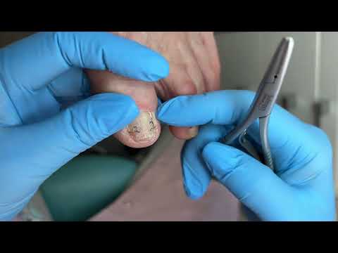 Видео: Установка системы 3ТО | работа с онихолитом | тампонирование