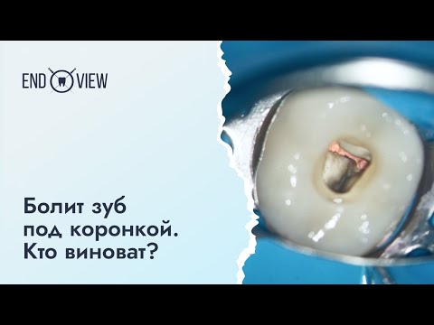 Видео: Болит зуб под коронкой - что делать?