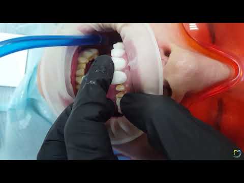 Видео: Установка циркониевых коронок - Стоматология «ECONOMSTOM»