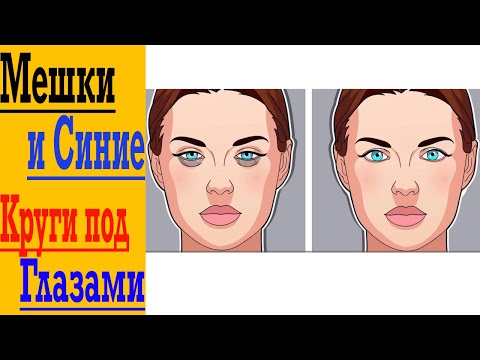 Видео: Избавляемся от Мешков и Синих Кругов под Глазами !