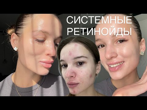 Видео: Системные Ретинойды Я ОТКАЗАЛАСЬ ОТ ЛЕЧЕНИЯ Роаккутан